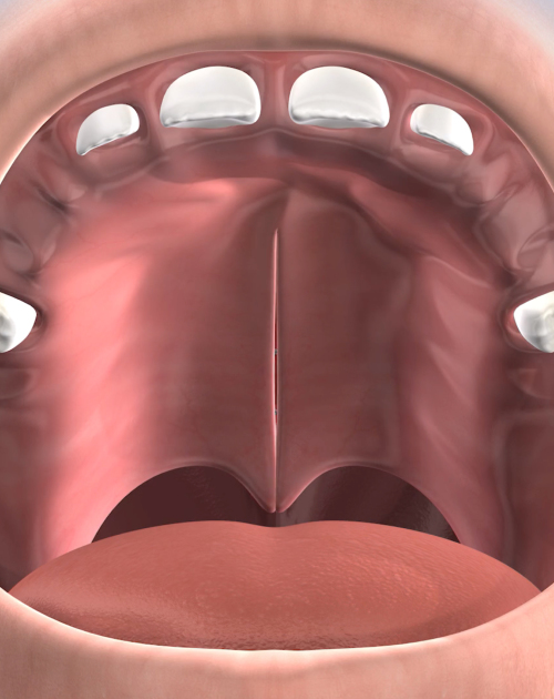 Cleft Lip Palate Repair In Boise Hailey Star And Twin Falls Id