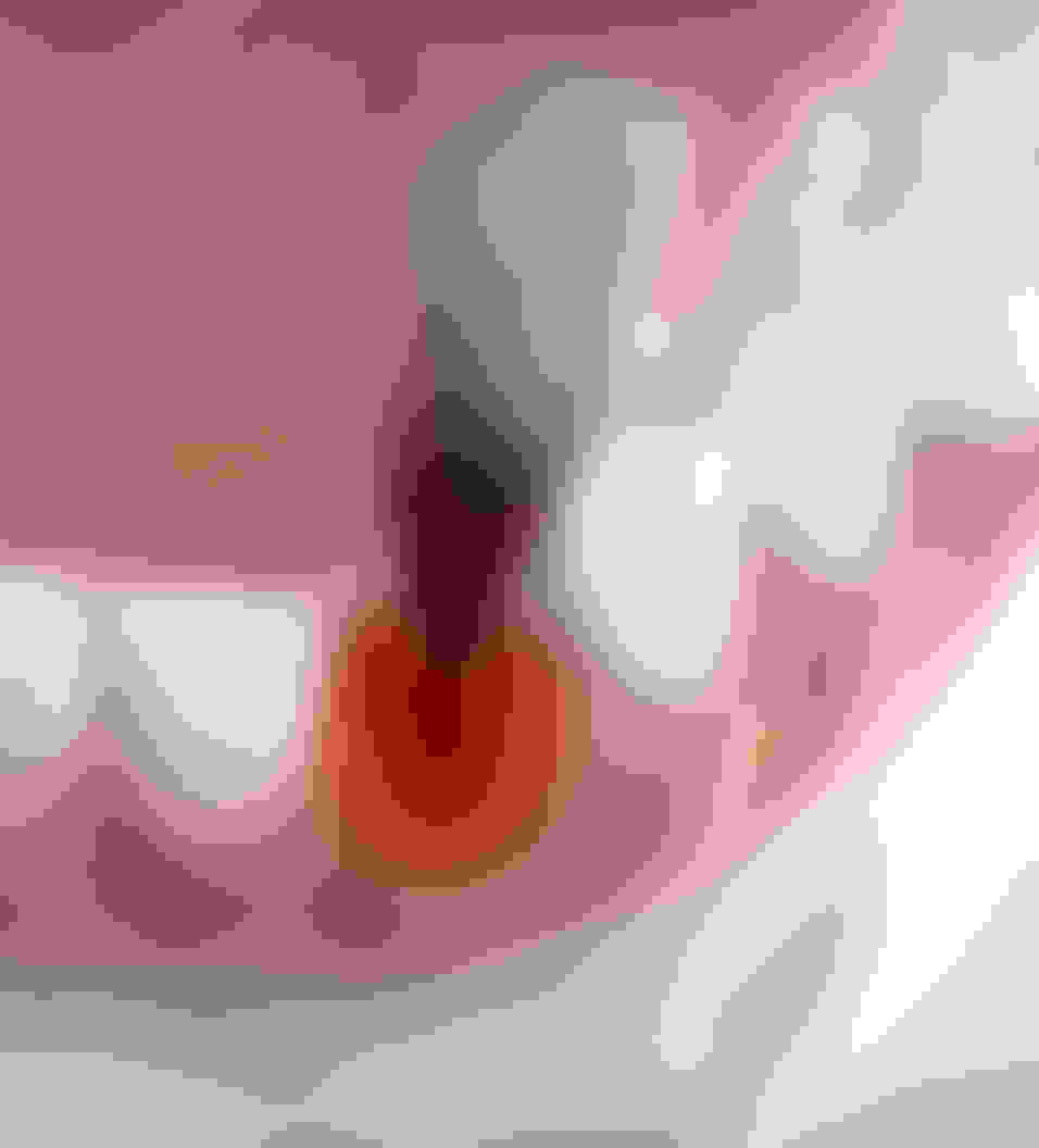 Query  tooth extraction