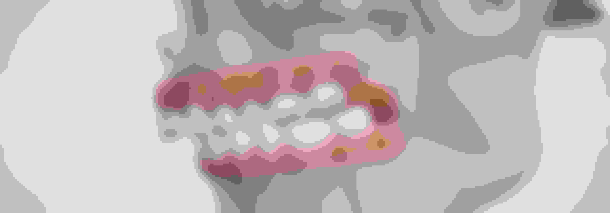 procedure  orthognathic jaw surgery  desktop