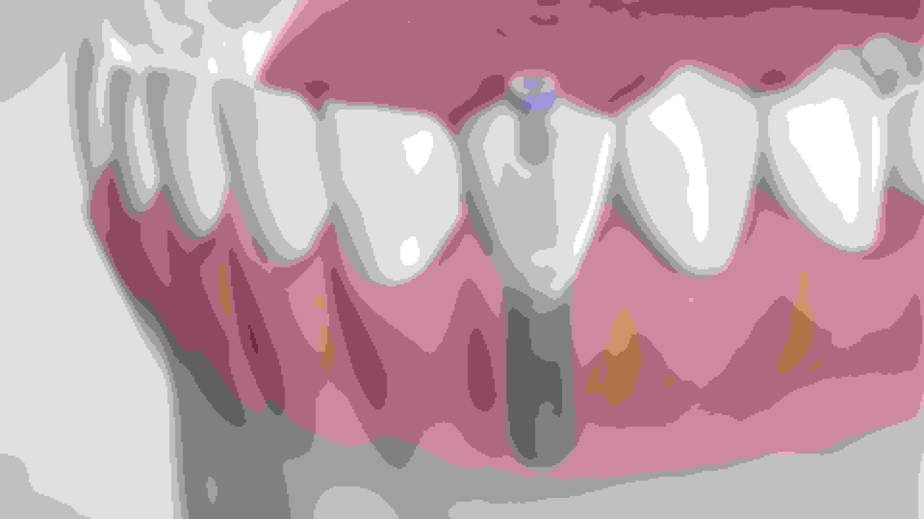 instruction  dental implant