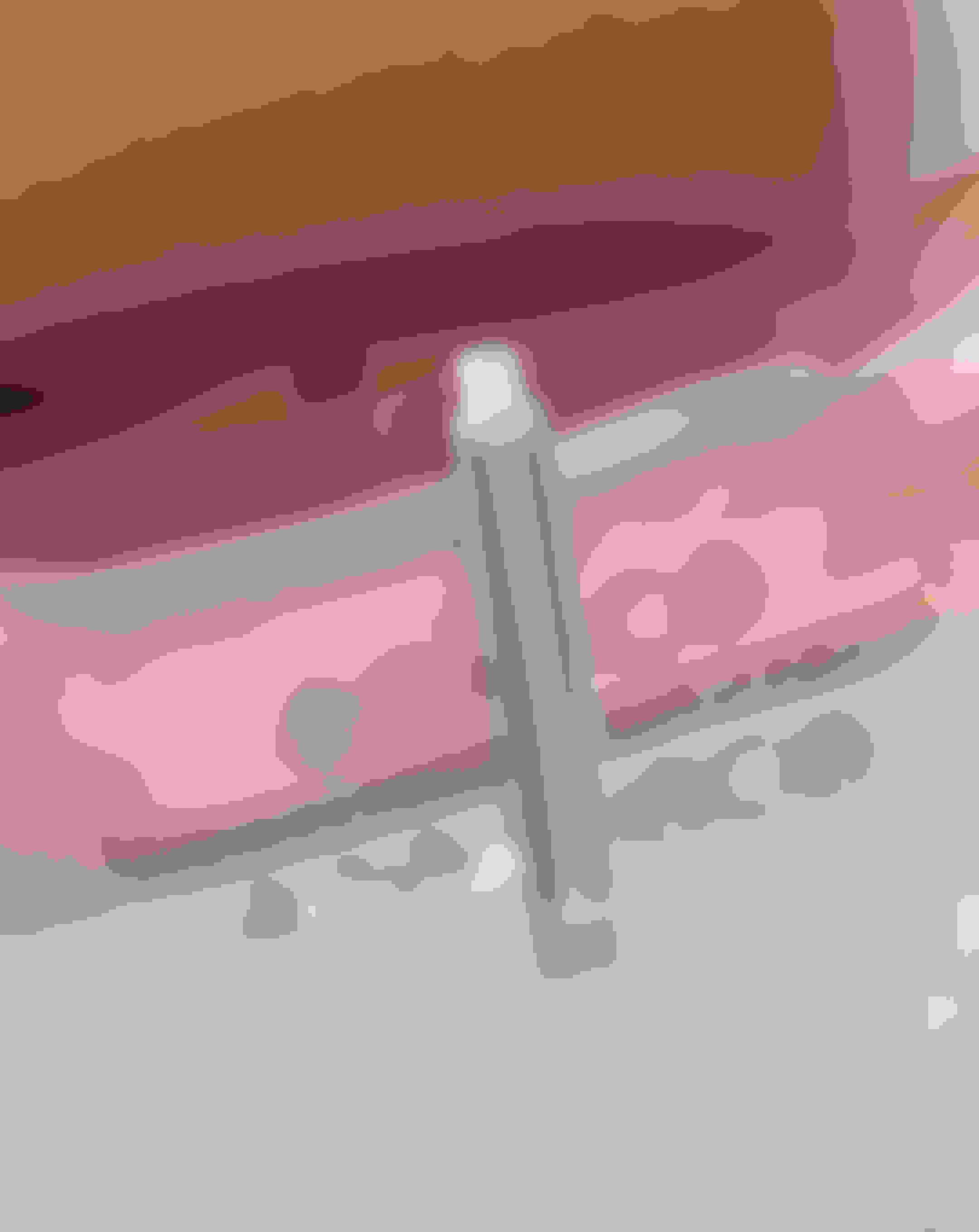 Distraction osteogenesis procedure mobile.jpg