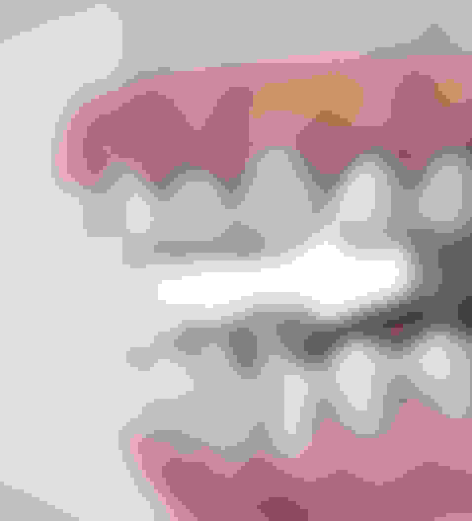 Full arch benefits procedure query page