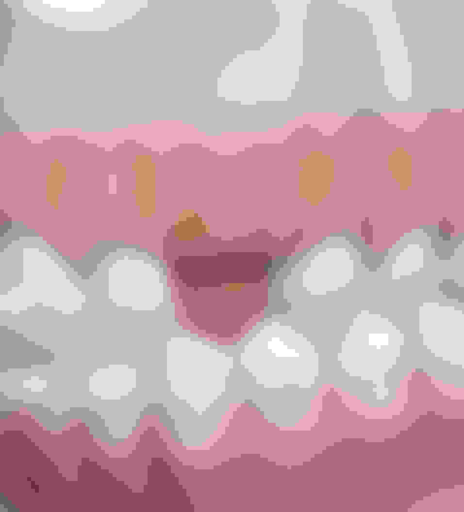 query  impacted canines2