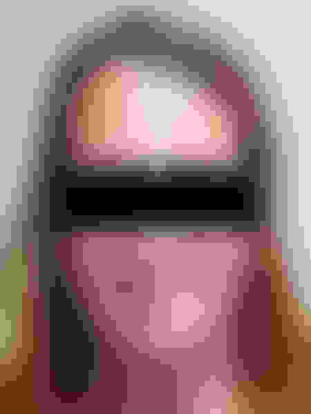 Implant surgery case 1 after 1