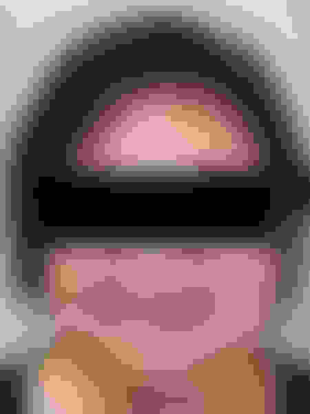 Implant surgery case 2 after 1