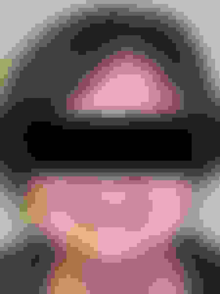 Implant surgery case 2 before 1