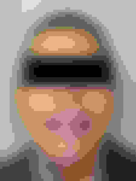 Implant surgery case 3 after 1