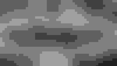 Implant surgery case 3 after 3