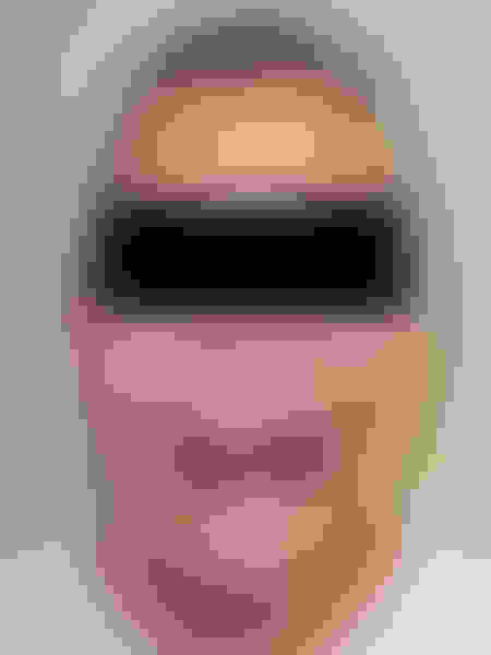 Implant surgery case 3 before 1