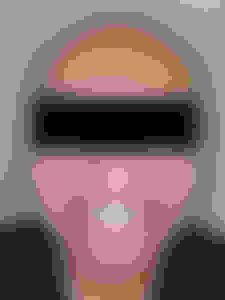 Implant surgery case 4 after 1