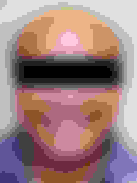 Implant surgery case 4 before 1