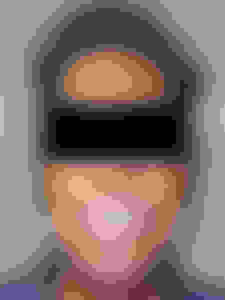 Implant surgery case 5 after 1