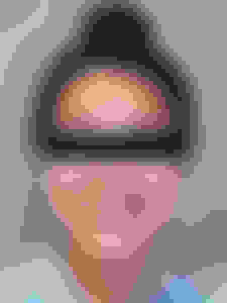 Jaw surgery case 3 after