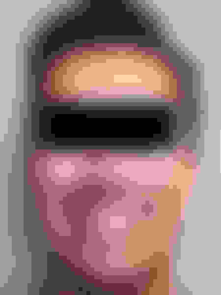 Jaw surgery case 4 after