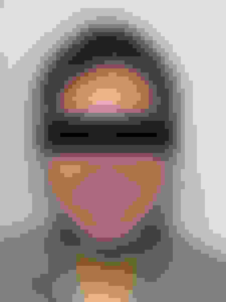 Jaw surgery case 5 after