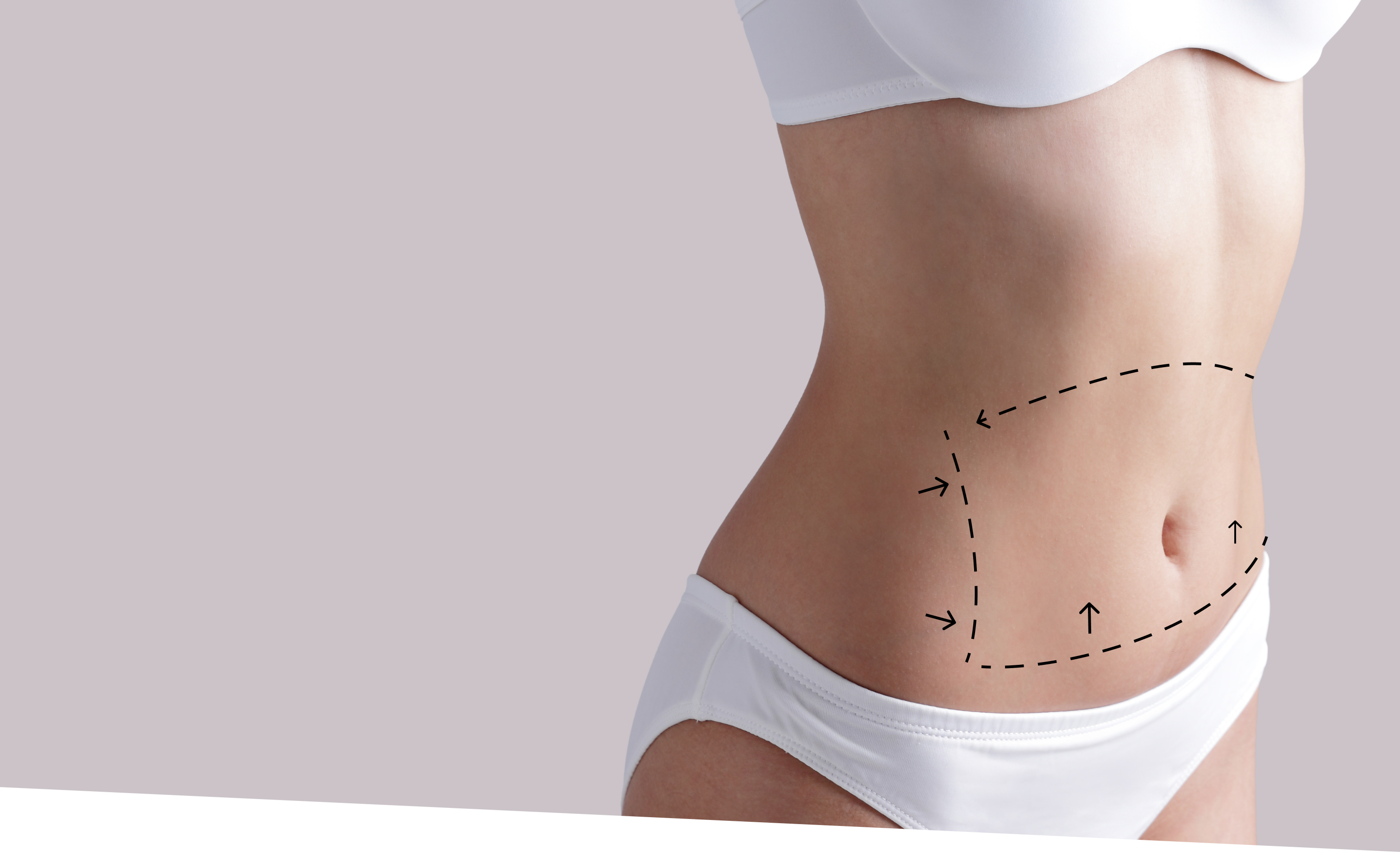 77 liposuction revision