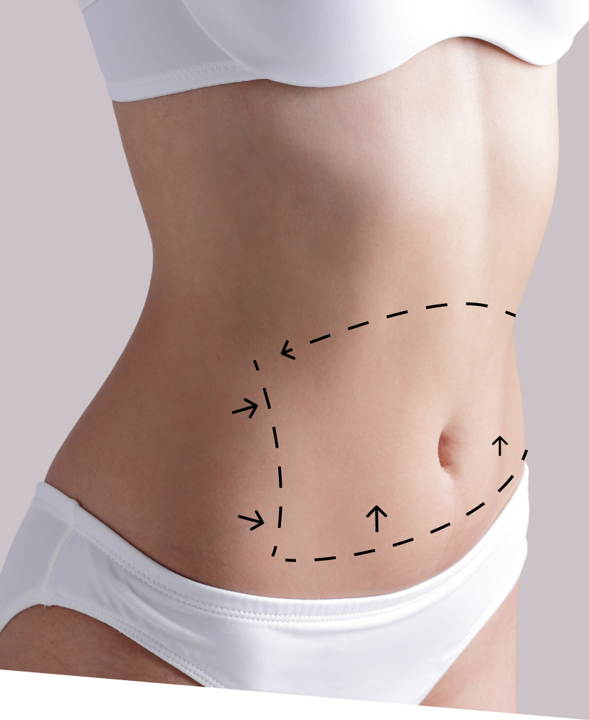 77 liposuction revision mobile