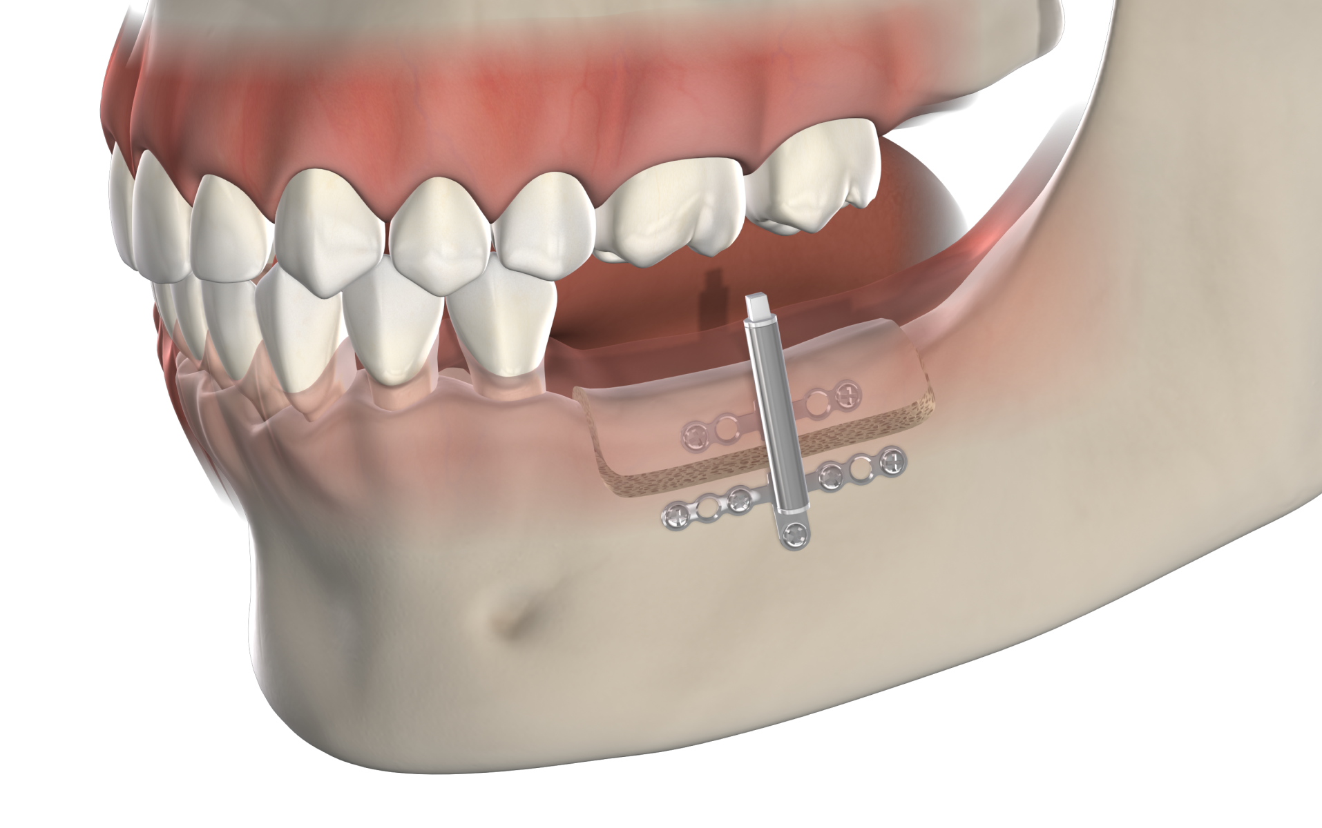 Isolated  distraction osteogenesis