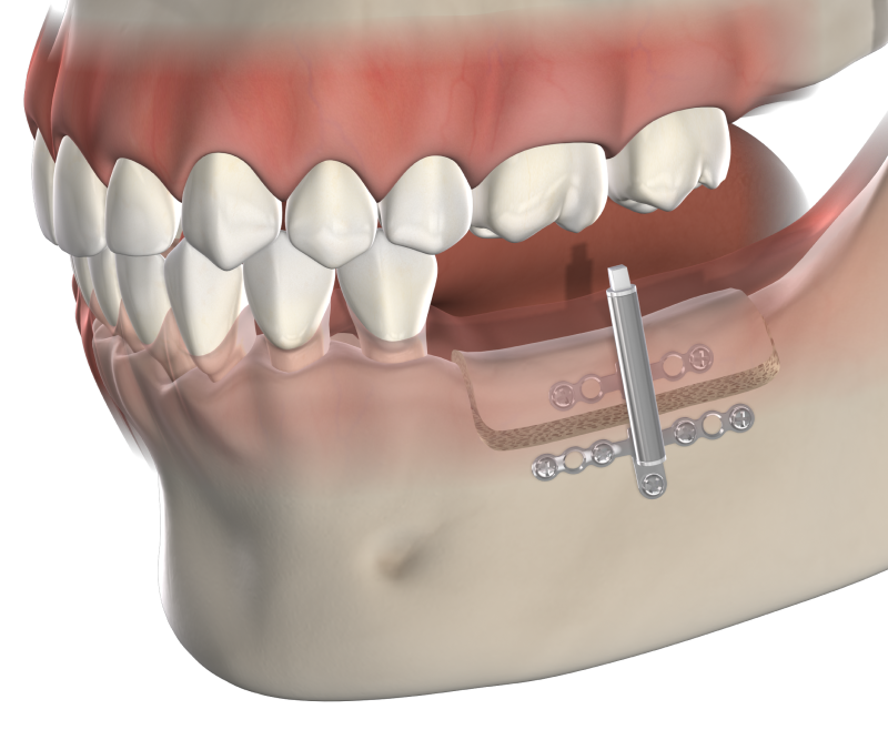 Isolated  distraction osteogenesis  mobile