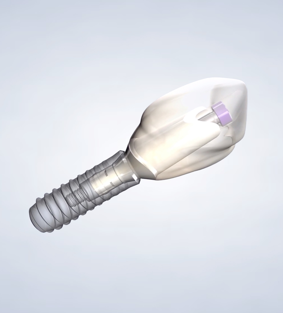 A dental implant.