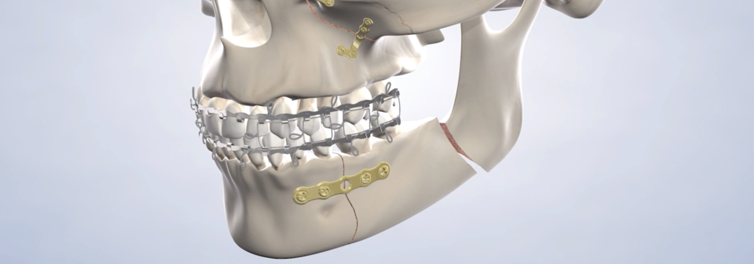 Jaw strapped with metal and kept aligned.