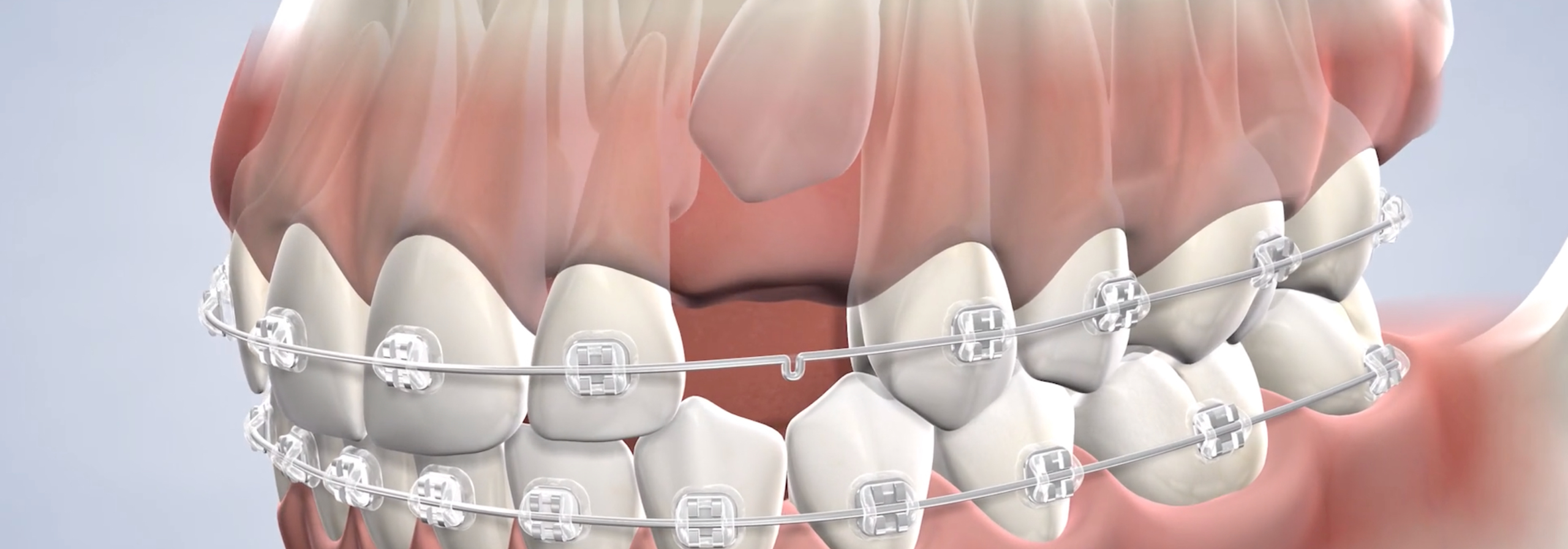 Tooth stuck between other teeth.