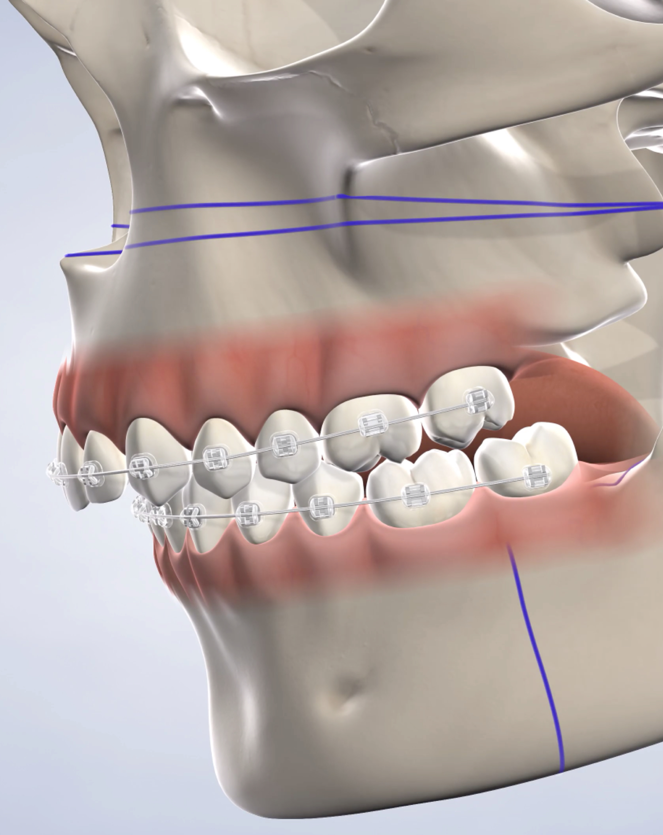 Realignment of jaw.