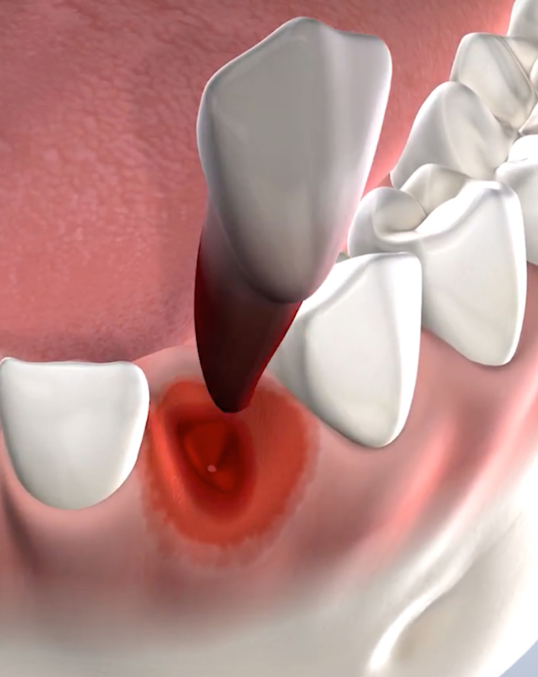 Tooth extracted from row of teeth.