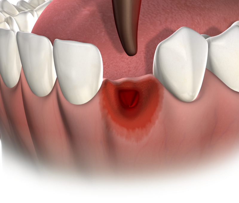 Isolated  tooth extractions  mobile