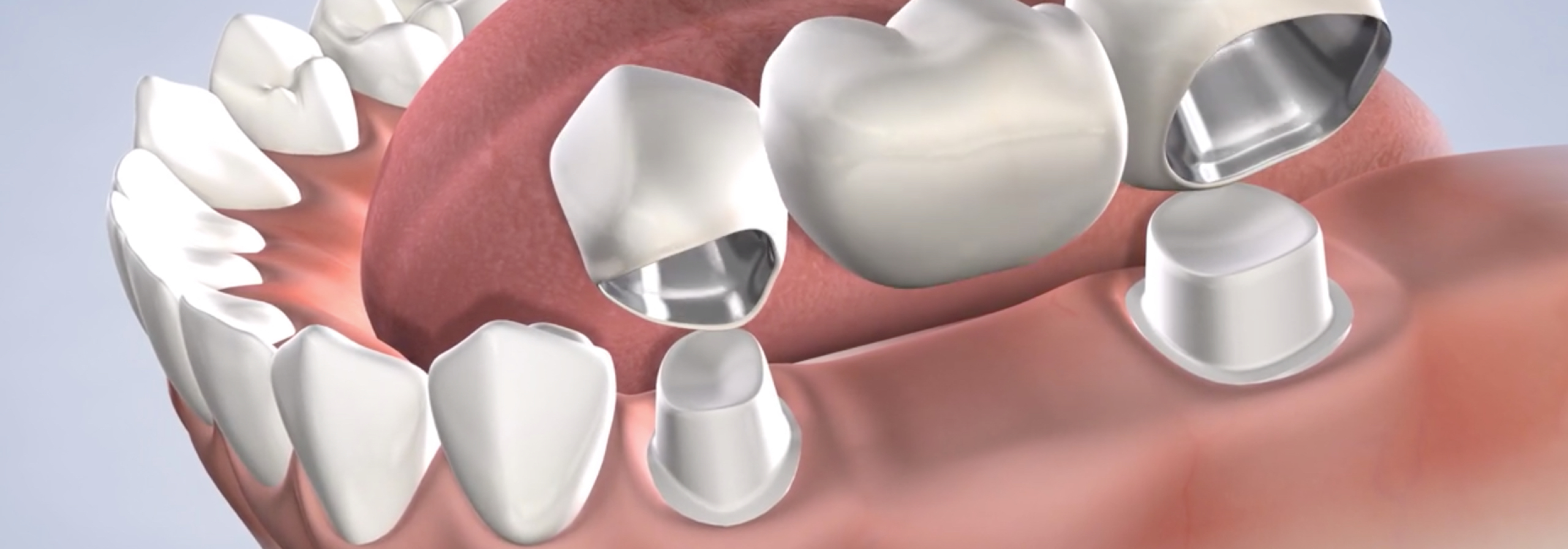 Procedure tooth replacement options video thumb