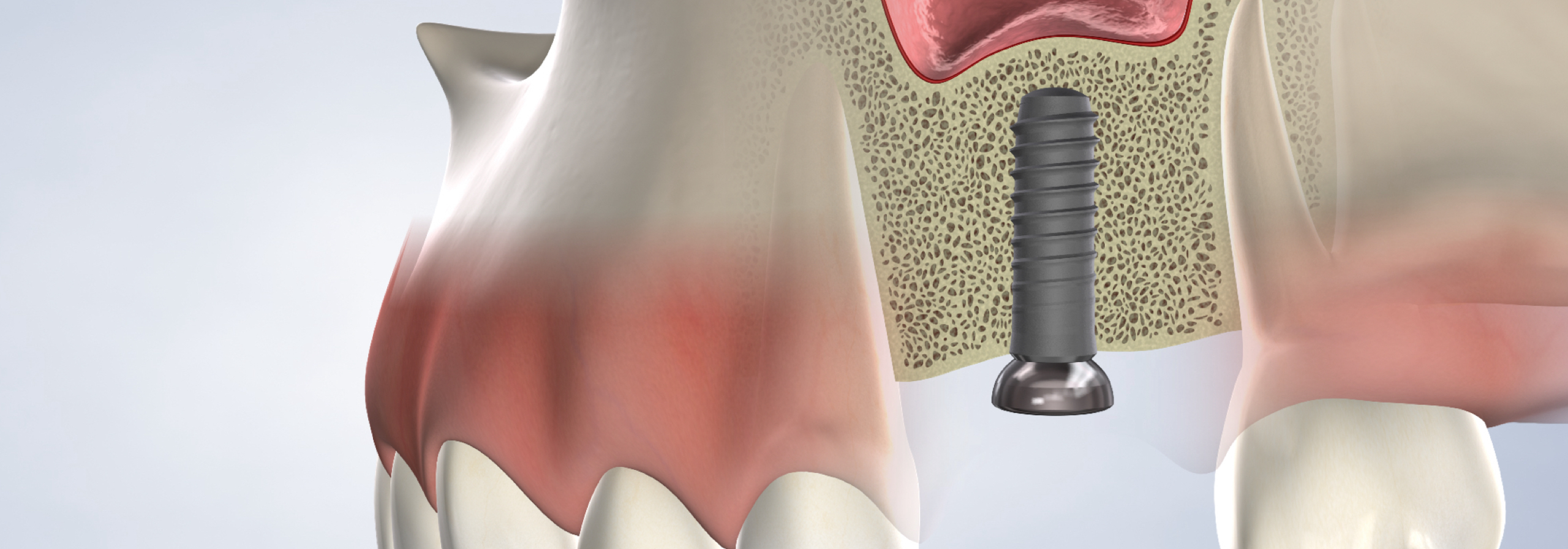 Bone Grafting in Norton Shores, MI Breakwater Oral Maxillofacial