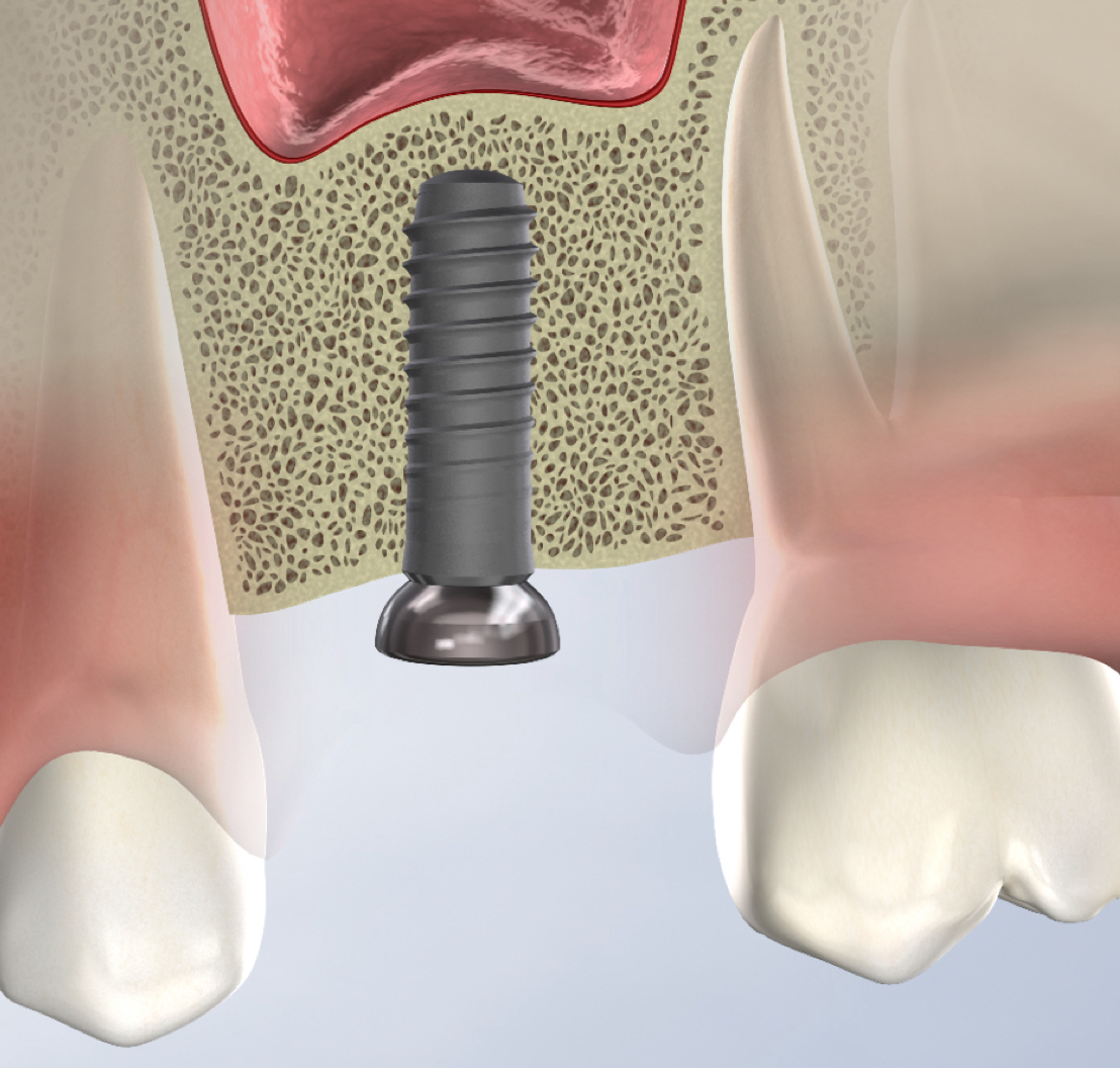 Bone Grafting in Norton Shores, MI Breakwater Oral Maxillofacial