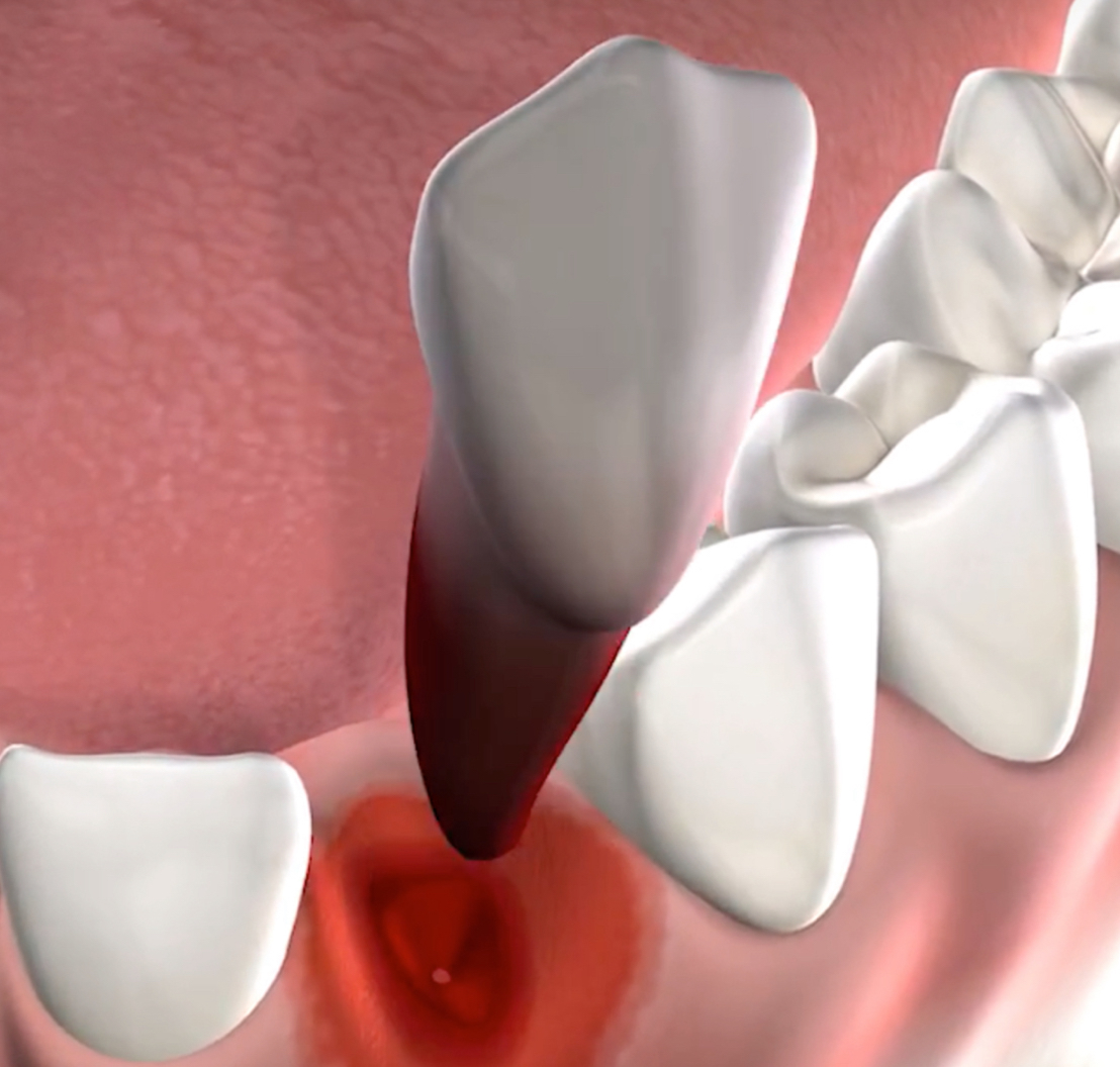 Tooth Extractions in Norton Shores, MI Breakwater Oral Maxillofacial