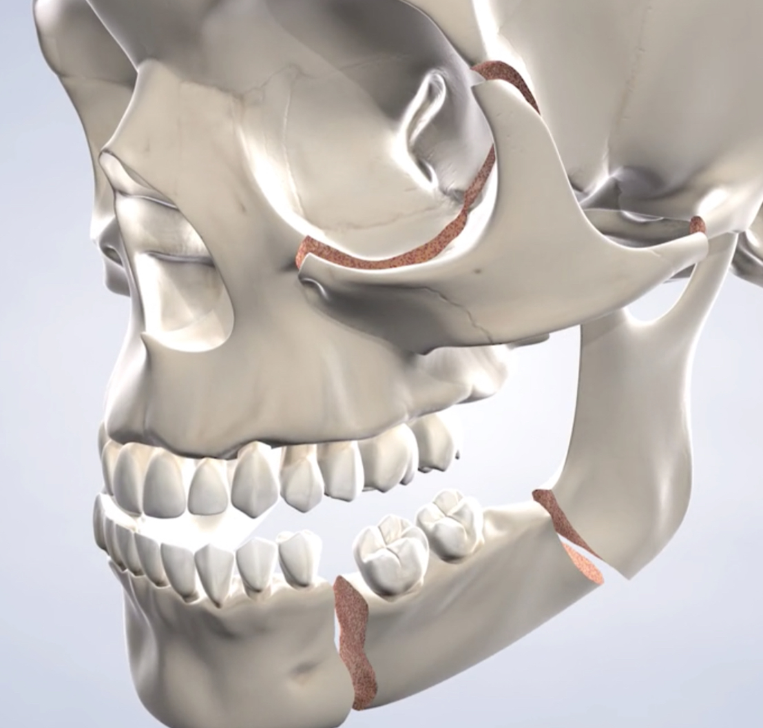 Facial trauma procedure mobile