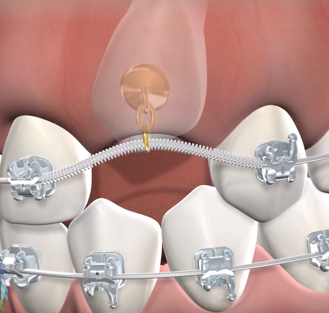 Impacted tooth exposure procedure mobile