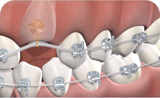 Impacted tooth exposure procedure query page