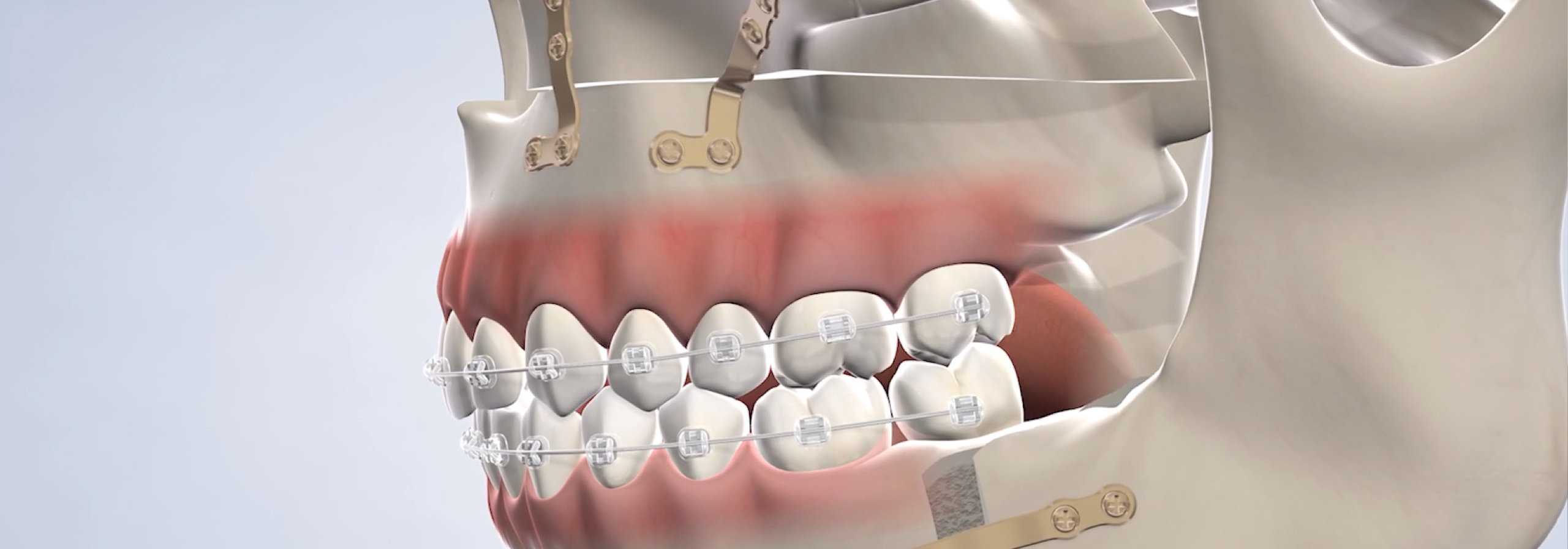 Jaw Surgery in Norton Shores, MI Breakwater Oral Maxillofacial