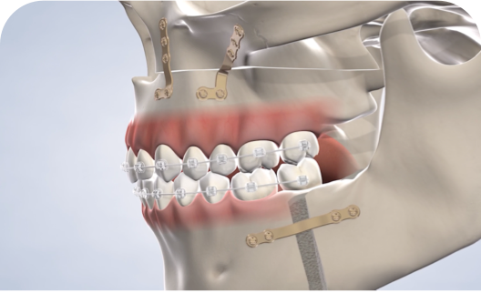 Jaw surgery procedure query page