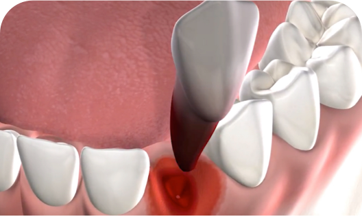 Tooth extraction procedure query page