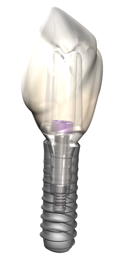 Isolated  dental implant