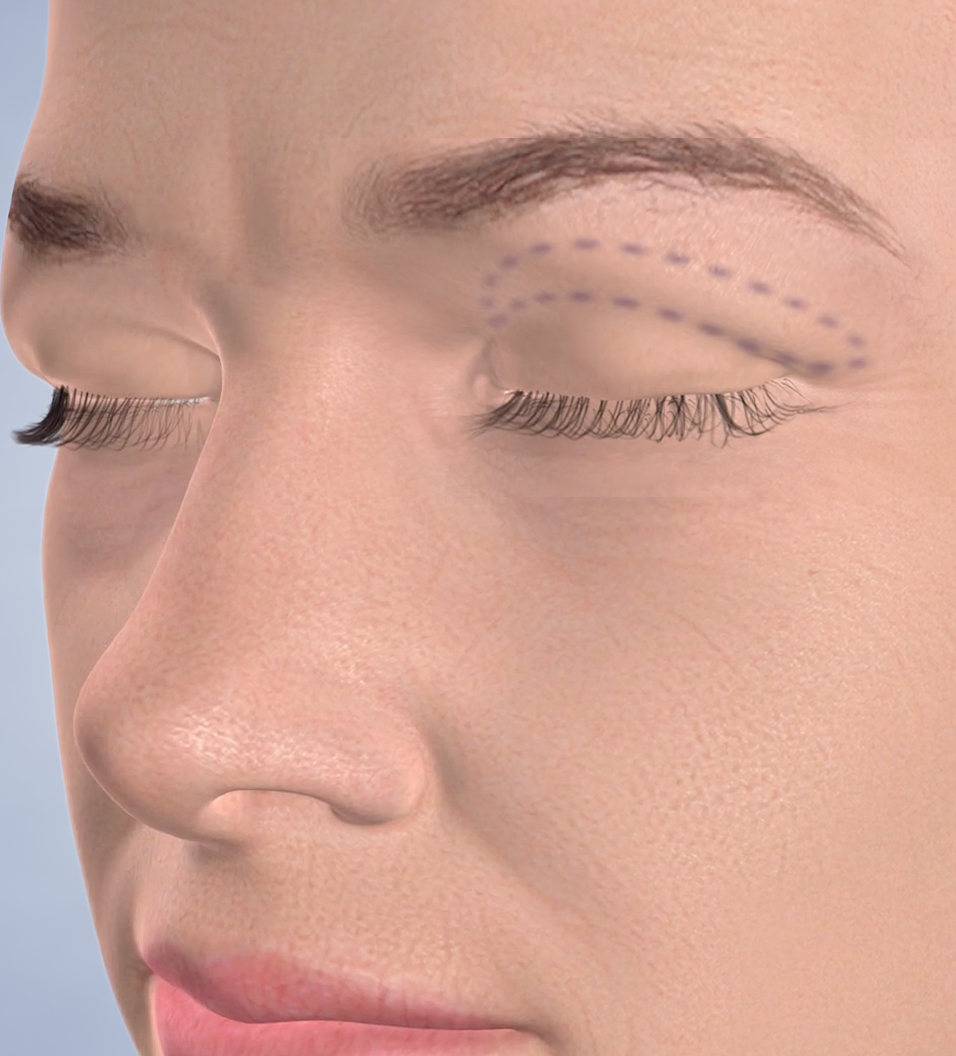 Query eyelid surgery