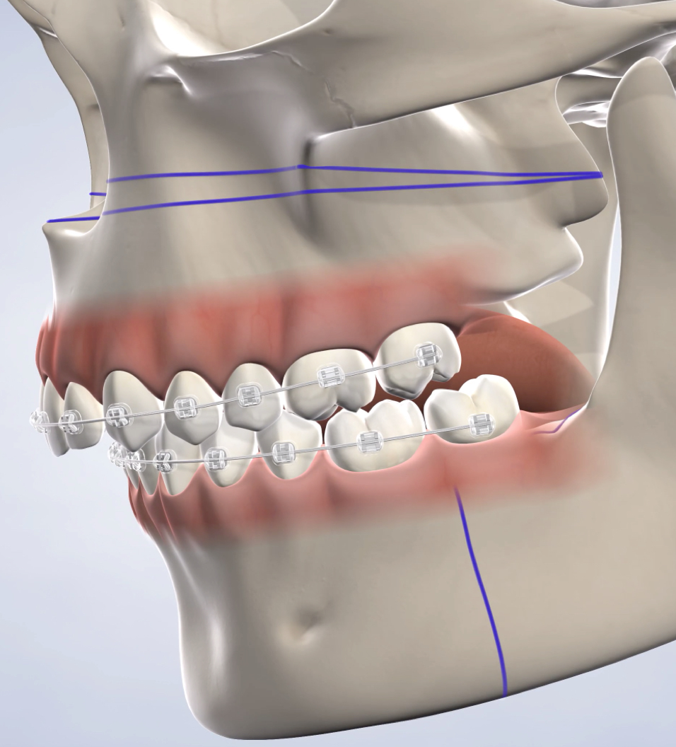 Query orthognathic jaw surgery
