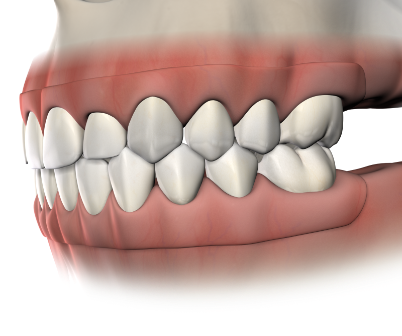 Isolated  pre prosthetic surgery  mobile