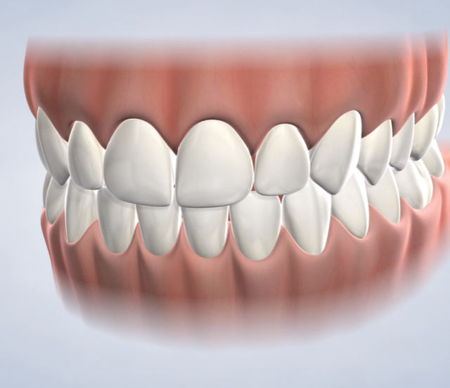 Icon® discolored tooth treatment in Dumas, Canyon, Amarillo, Farwell, and Dalhart, TX