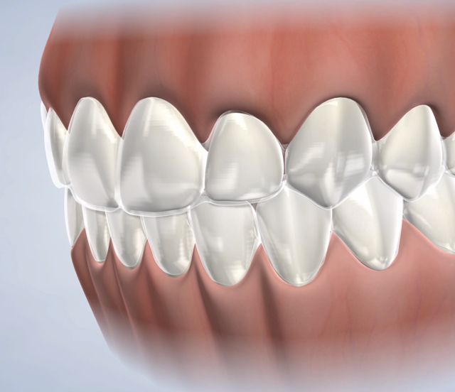 Teeth whitening in Dumas, Canyon, Amarillo, Farwell, and Dalhart, TX