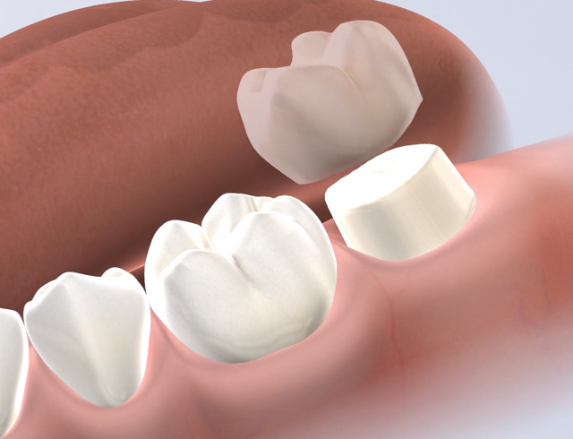 Dental crowns in Dumas, Canyon, Amarillo, Farwell, and Dalhart, TX