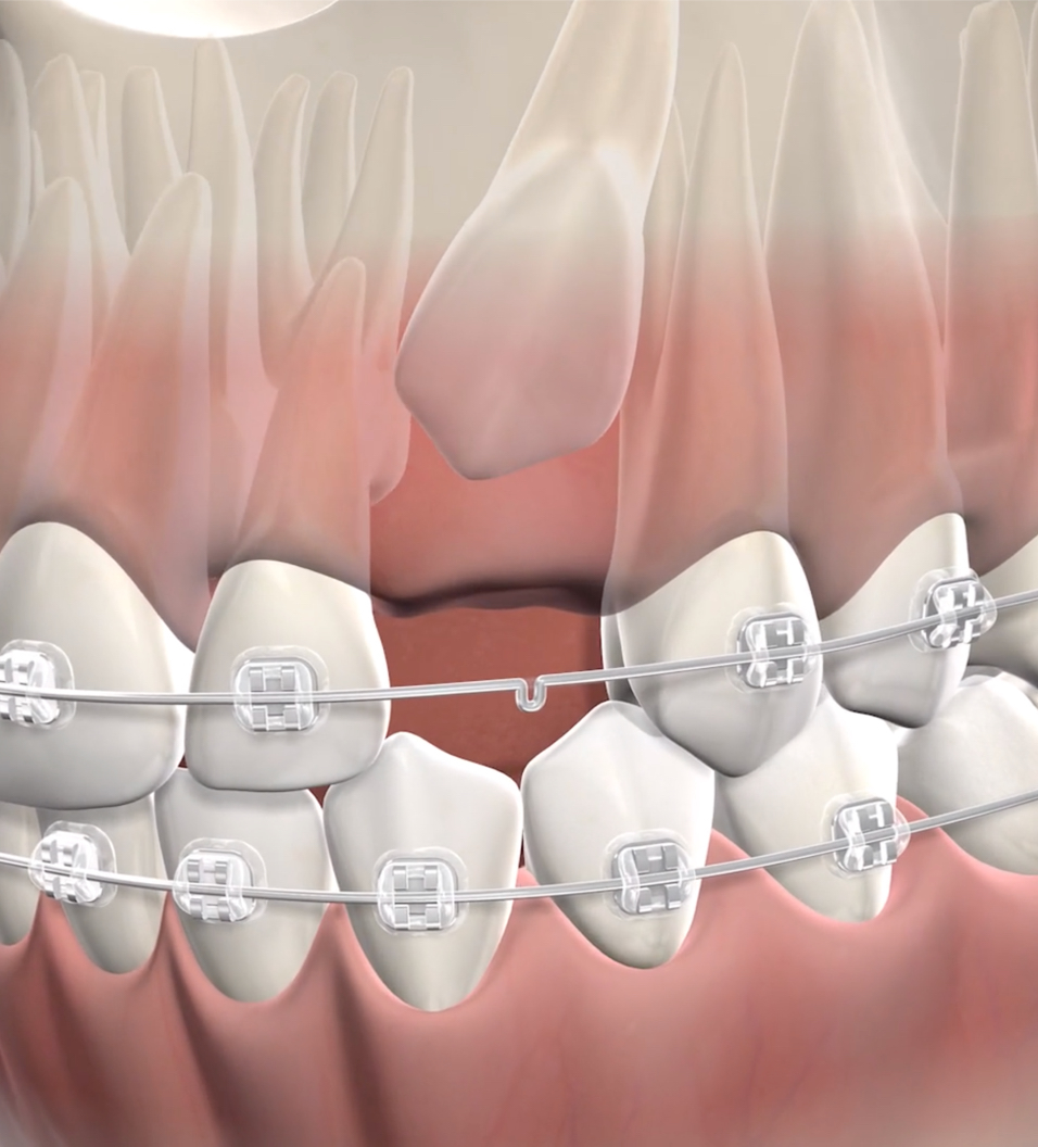 Impacted-canines-procedure-query-page_2
