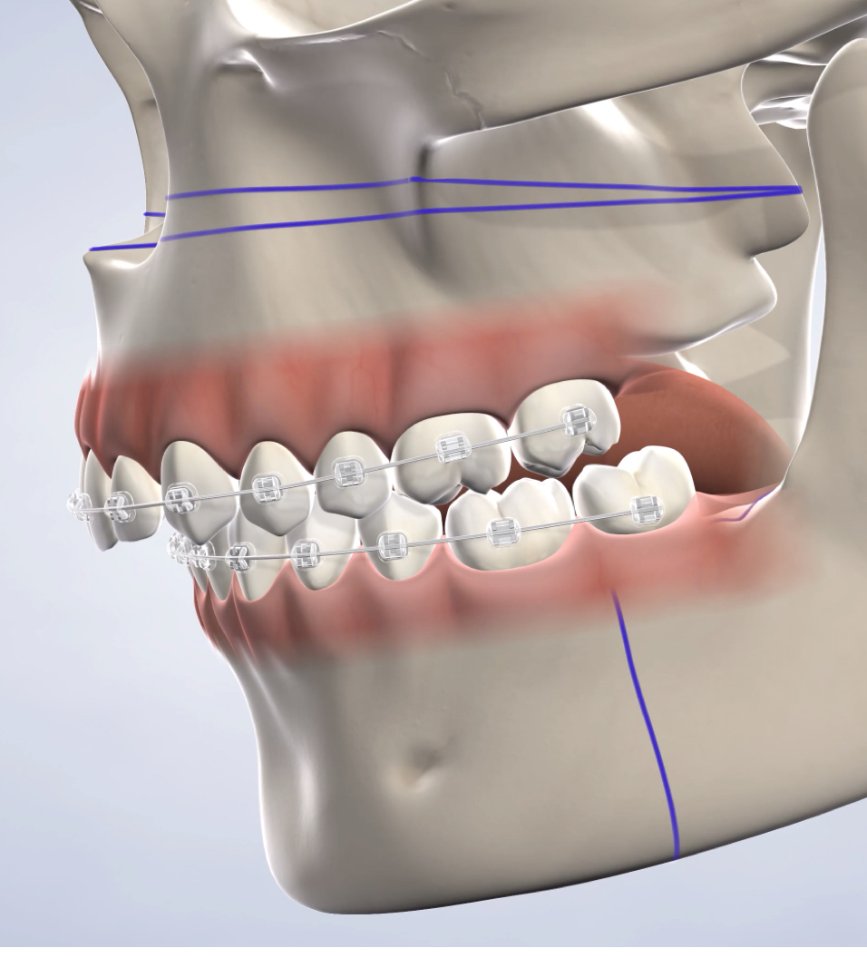 Jaw-surgery-procedure-query-page