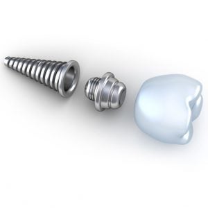 Dental Implant e 300x300