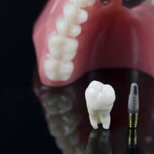 Dentalimplant3 2 300x300